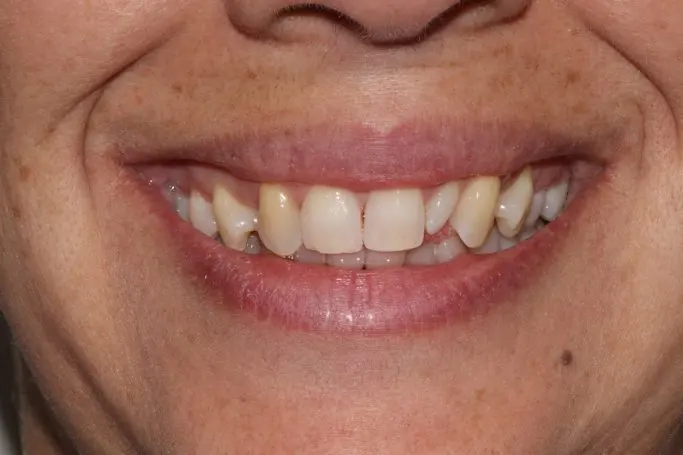 Antes Blanqueamiento dental