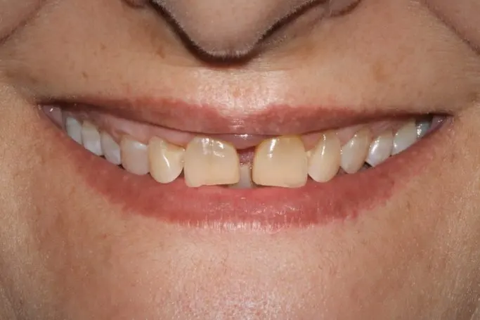 Antes Cierre de diastema
