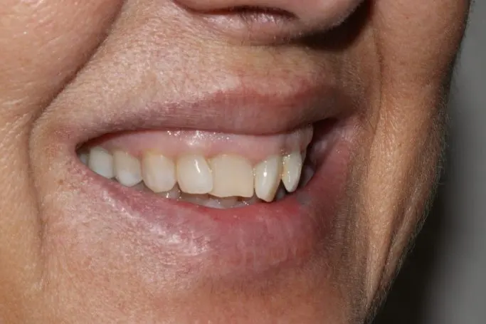 Antes Coronas de zirconio