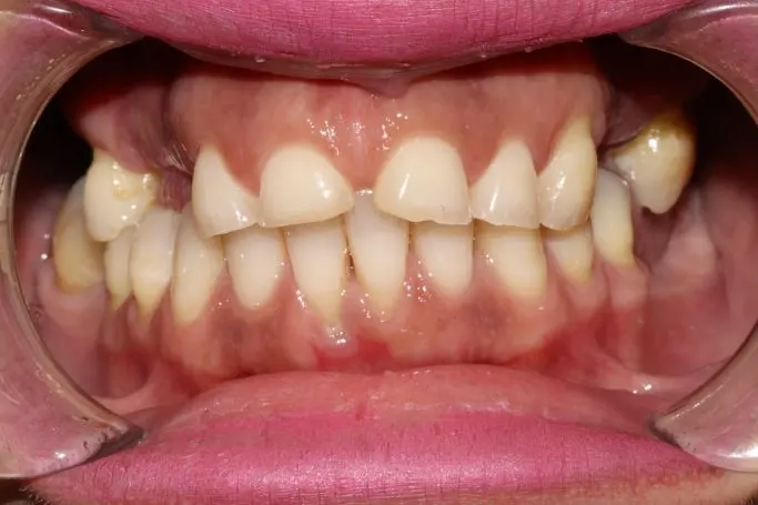 Antes Diseño de sonrisa