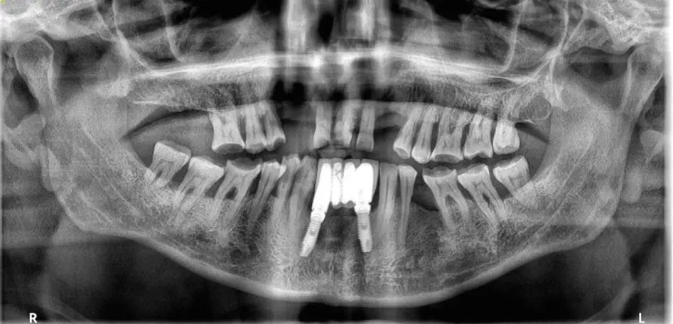 Antes Rehabilitación sobre implantes