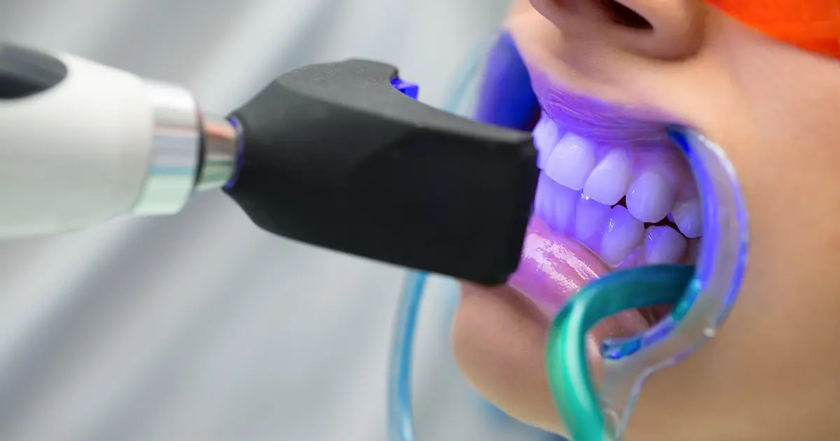 Blanqueamiento dental en Santa Cruz de Tenerife