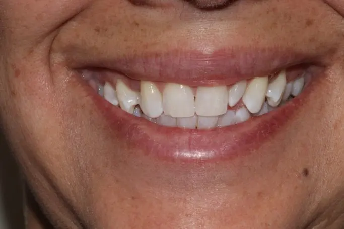 Después Blanqueamiento dental