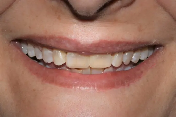 Después Cierre de diastema