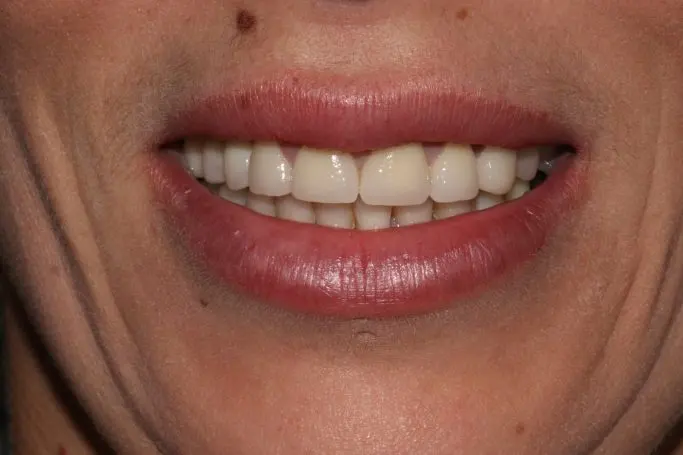 Después Diseño de sonrisa